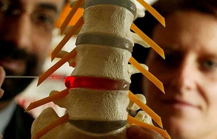Changes in integrity of intervertebral disks