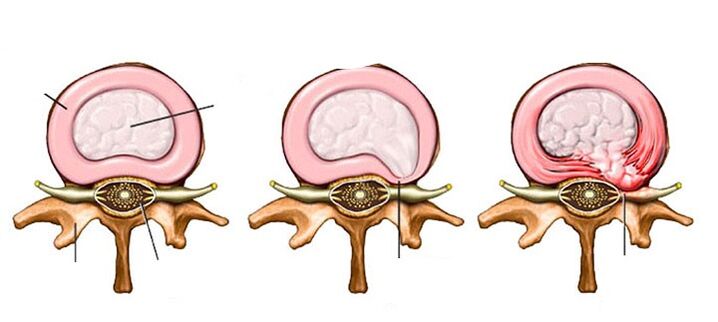 Vascular changes