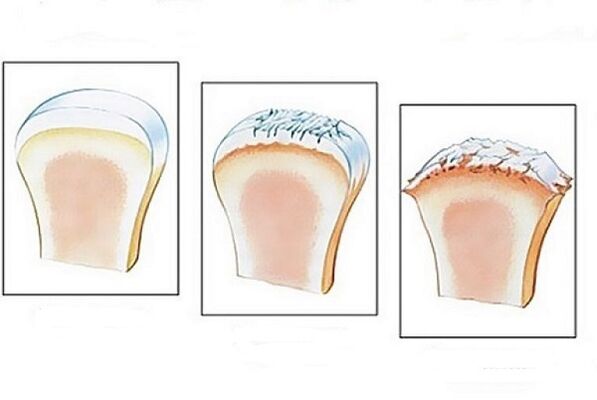 joint damage at different stages of osteoarthritis development