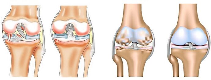The difference between arthritis (left) and arthrosis of the joints (right)