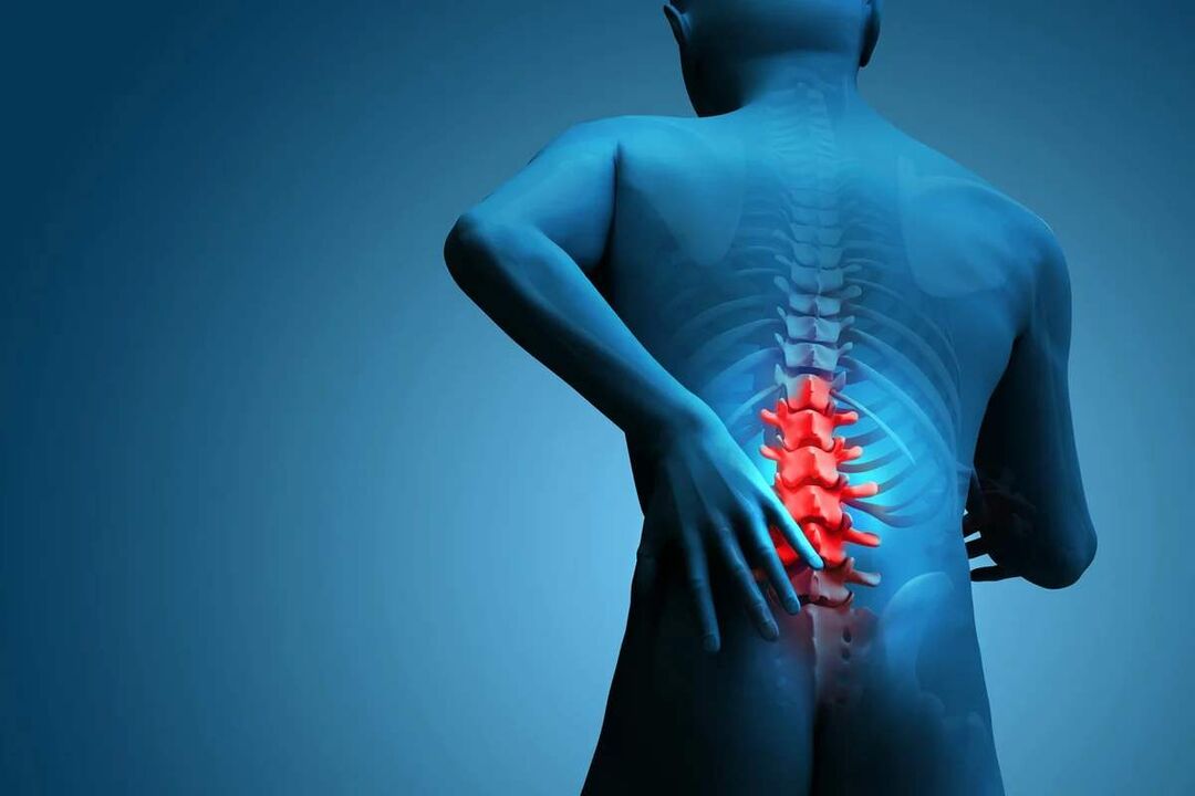 The main symptom of lumbar osteochondrosis is back pain. 