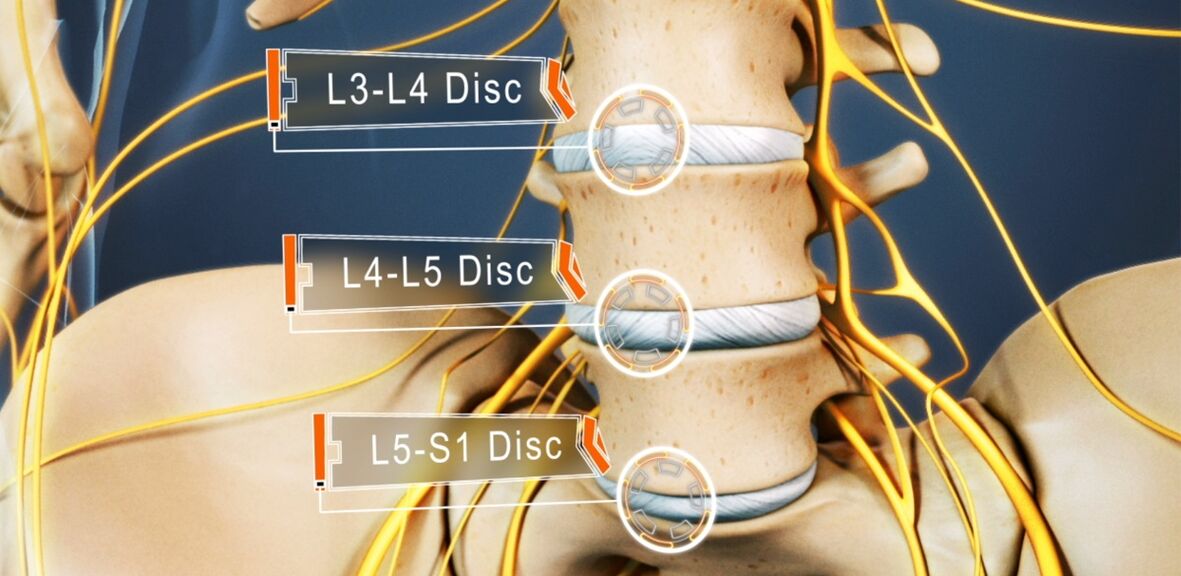 The most affected lumbar discs in osteochondrosis