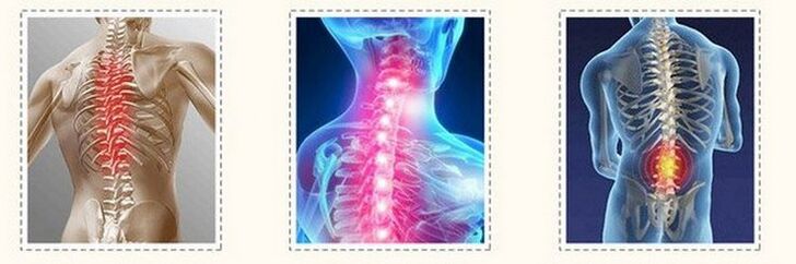 Osteocondrosis of different spine