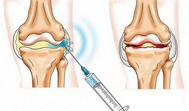 Blocking of knee joint for Arthosis