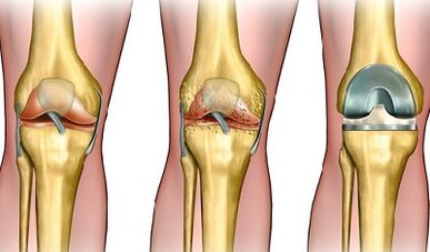 Development rate of arthrosis of knee combination
