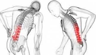 INTERVERTEB Hernia - Complication with osteocondrosis
