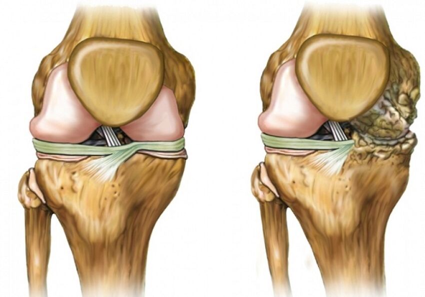Arthaz of the knee