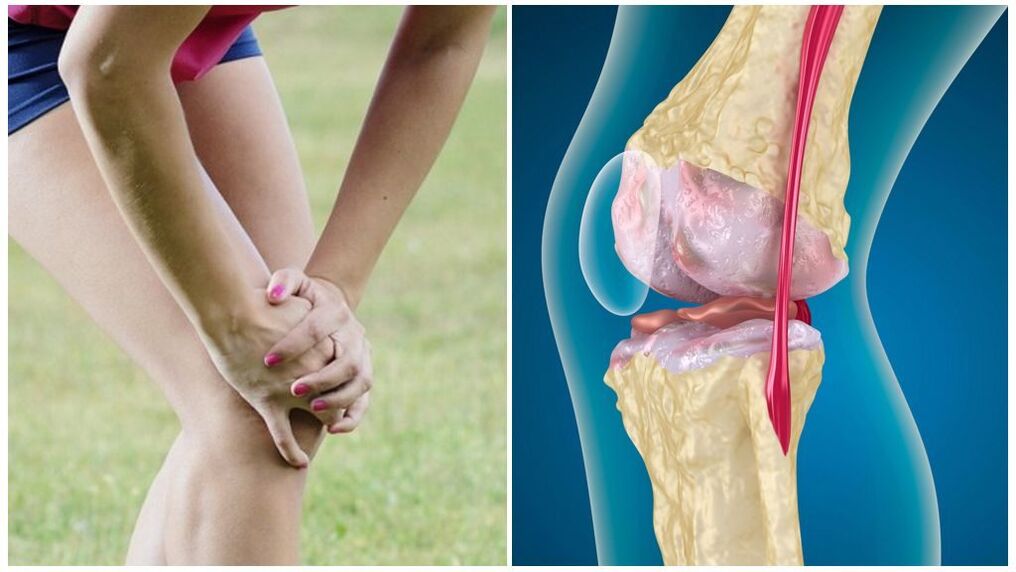 Symptoms of Artrosis