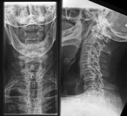 Cervical X -Ray - a diagnosis of osteocondrosis
