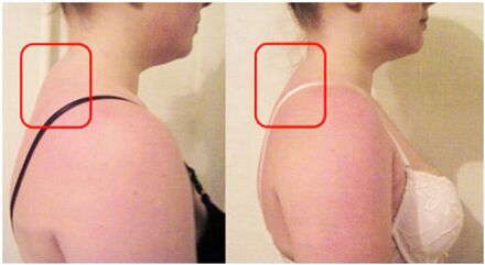 The formation of muscle rollers with cervical osteochondrosis