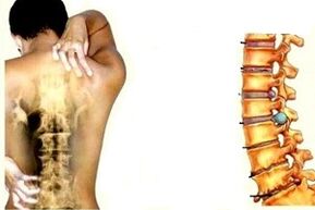 Back pain at various stages of cervical osteocondrosis
