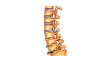 Damage to spine with cervical osteocondrosis