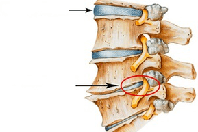 Normal and damaged spine with cervical osteocondrosis