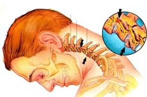 Pinch the nerve of the spine with cervical osteochondrosis