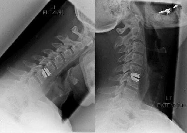 Image of the spine after surgery