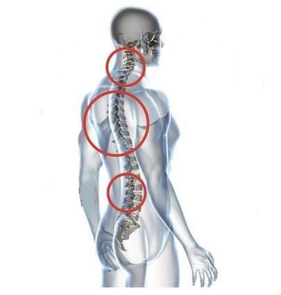 Sites of spinal osteochondrosis
