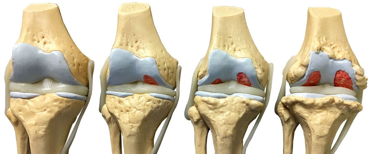 stages of arthrosis