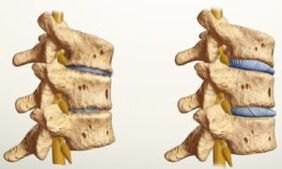 What does osteochondrosis look like