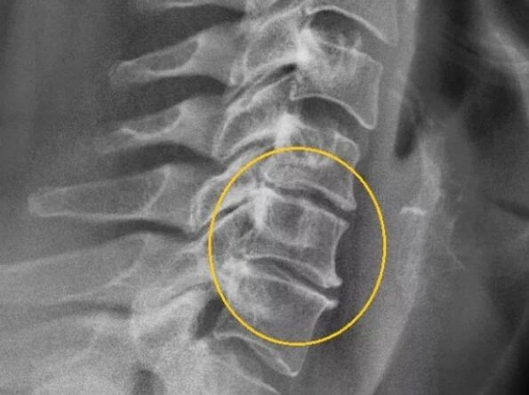 Osteochondrosis of the cervical spine on X-ray
